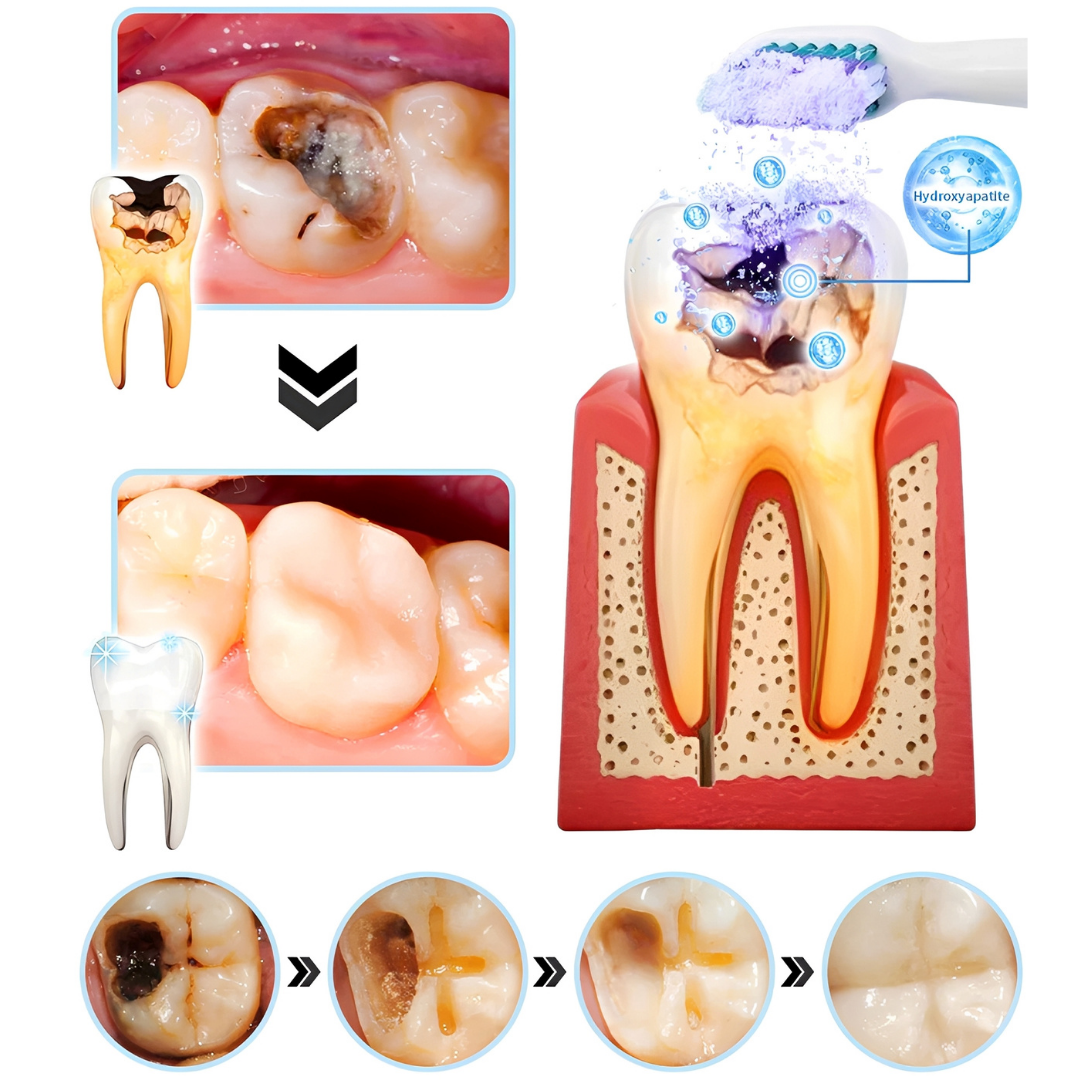 ODALIT™ – Réparation dentaire à domicile – Poudre minérale pour dents et gencives – Soulage parodontite, aphtes et inflammations