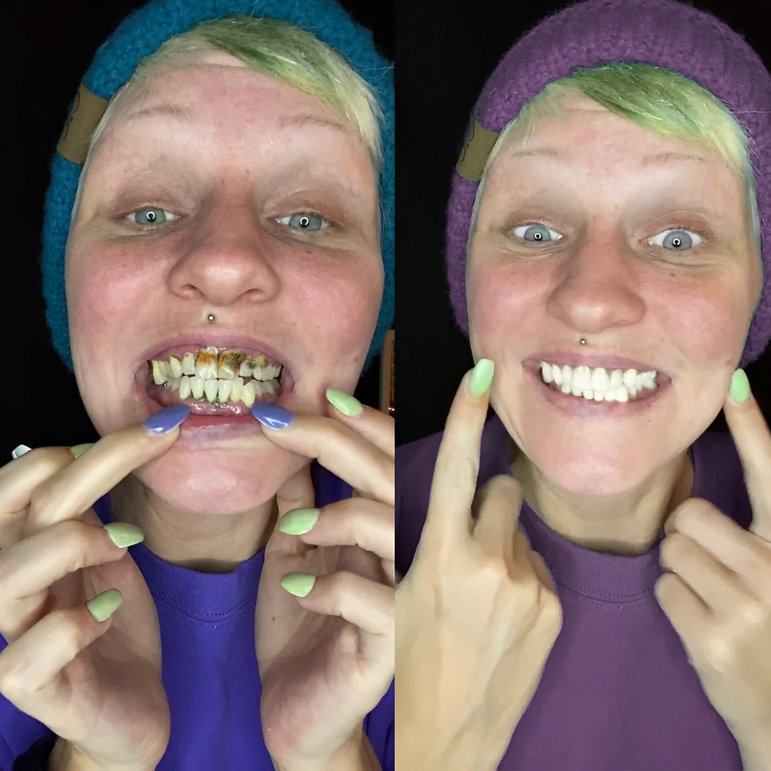 ODALIT™ – Réparation dentaire à domicile – Poudre minérale pour dents et gencives – Soulage parodontite, aphtes et inflammations