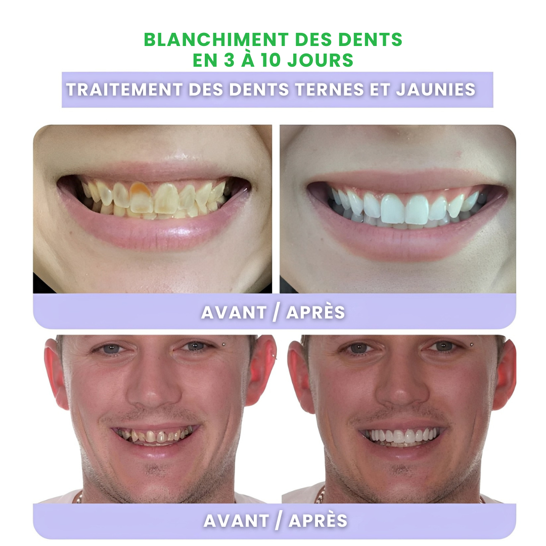 ODALIT™ – Réparation dentaire à domicile – Poudre minérale pour dents et gencives – Soulage parodontite, aphtes et inflammations