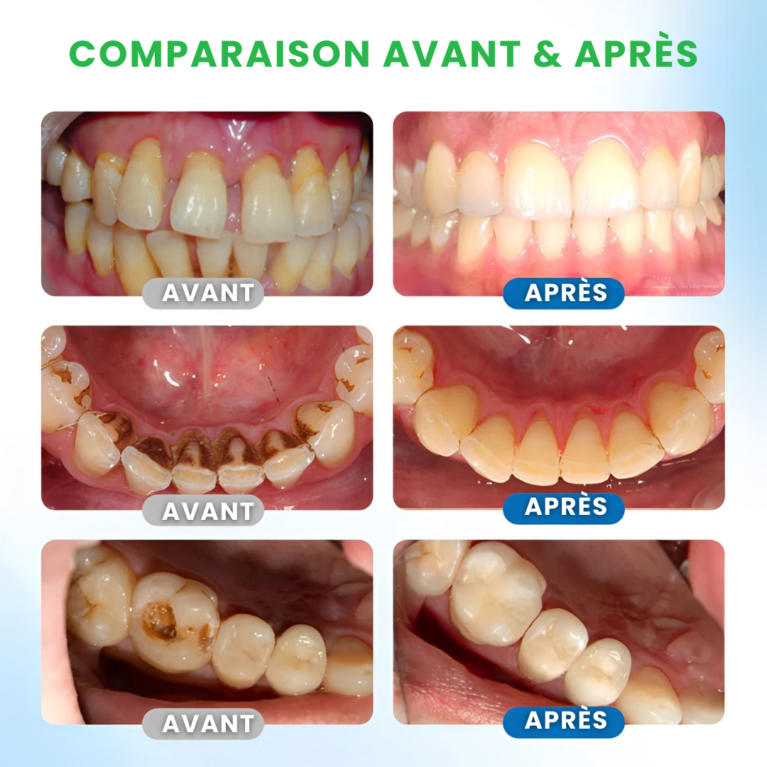 Sérum de Défense Dentaire LBMLBM™ – Protection Avancée & Renforcement Visible de l’Émail