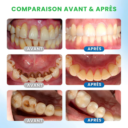 Sérum de Défense Dentaire LBMLBM™ – Protection Avancée & Renforcement Visible de l’Émail