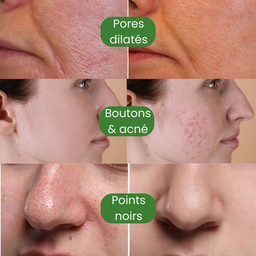 MASK® – Le Stick Nettoyant qui Élimine les Points Noirs en 10 Minutes